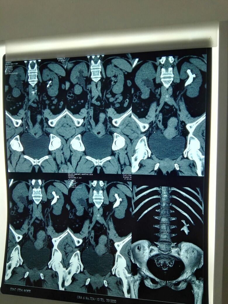 Calculo complejo , coliforme