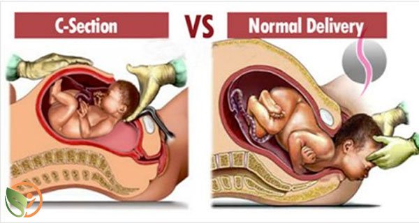 HealthyFit_org's tweet photo. FACTS ABOUT NORMAL VS C-SECTION DELIVERY, ALL WOMEN MUST KNOW!
https://t.co/ftEqkpfaGu
#women #baby #delivery https://t.co/f8ZBsEKxzN