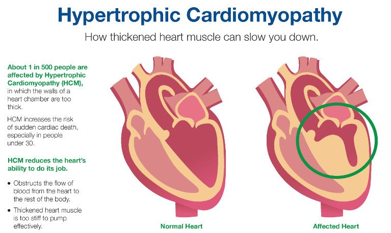 MayoClinic's tweet photo. #HypertrophicCardiomyopathy: How thickened #heartmuscle can slow you down. https://t.co/cshkZucedK https://t.co/rmmMUeODWh