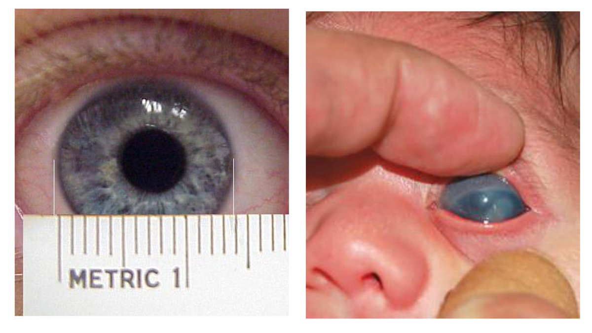 Glaukoma kongenital. Tampak adanya megalokornea, buftalmos (bertambahnya diameter bola mata), dan pengeruhan difus kornea.