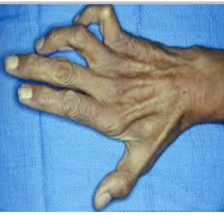 Claw Hand pada paralisis nervus ulnaris.