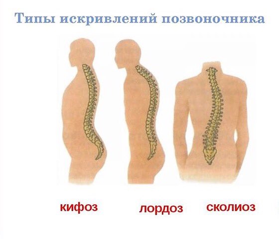 Нарушение изгиба позвоночника. Сколиоз боковое искривление позвоночника. Лордоз грудного отдела позвоночника. Искривление позвоночника лордоз кифоз сколиоз. Деформации позвоночника ( сколиоз, лордоз, гиперкифоз).