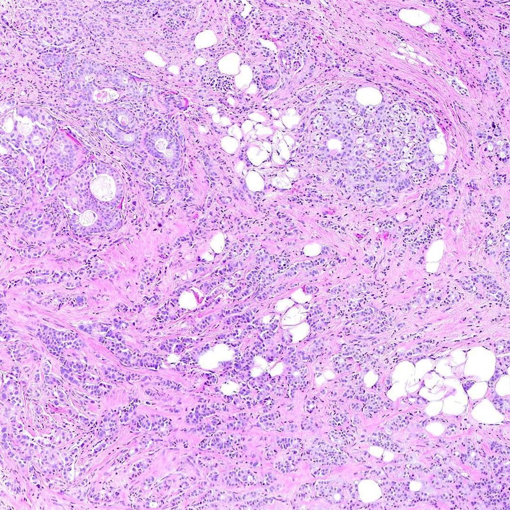 #invasiveductalcarcinoma of the #breast (1of3) ... #pathology #histology #breastcancer #br… ift.tt/2eKTYyJ