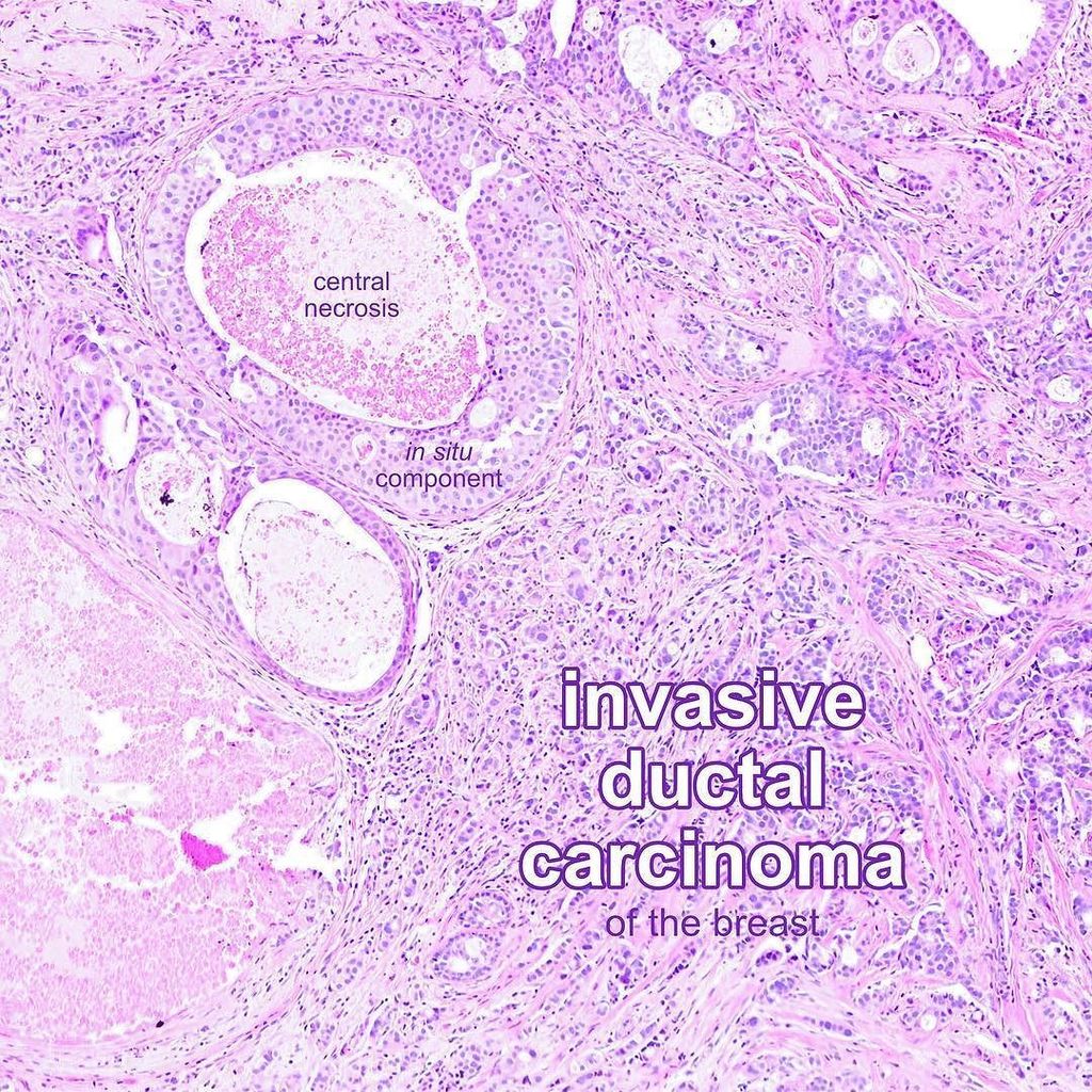 #invasiveductalcarcinoma of the #breast (2of3) with an intermixed #insitu component with c… ift.tt/2g3qfGl