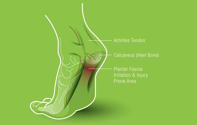 Do you have plantar fasciitis? We can treat this in just a few short osteopathic sessions. Spots available tomorrow with Katie #miltonON