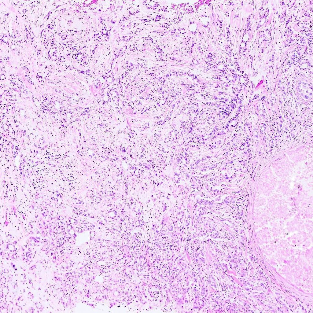 #invasiveductalcarcinoma of the #breast (3of3) ... #pathology #histology #breastcancer #br… ift.tt/2eL0nK4