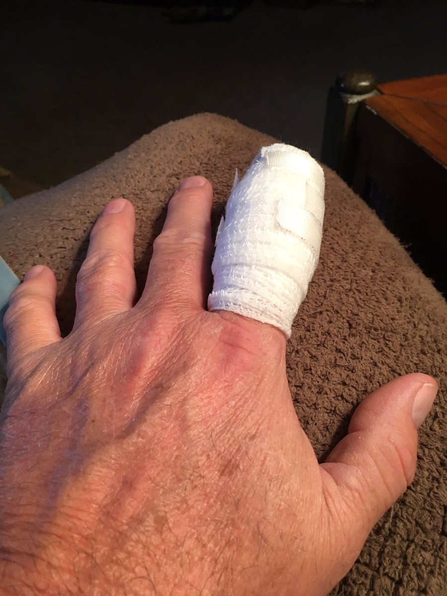 MitchFeltmeyer's tweet photo. Knife slipped while sharpening it to help skin a deer my son shot last night. 4 stitches. https://t.co/kMflUstlJW