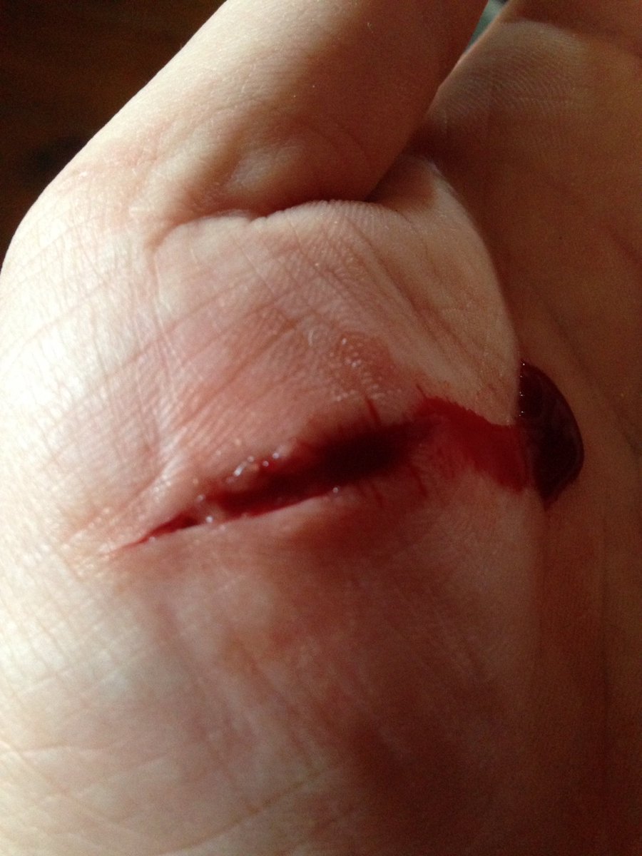 waynejackon's tweet image. No good at diy scraping paint end up hours in a+e with a few stitches