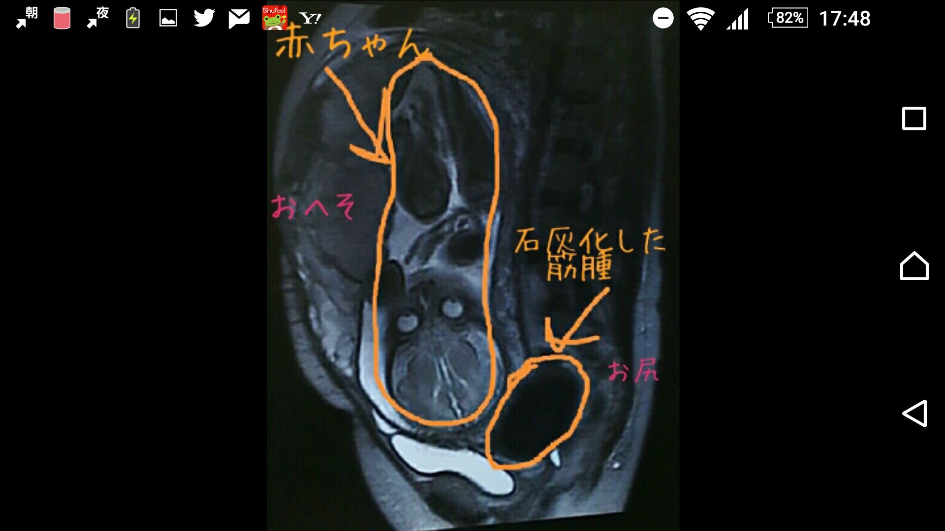 Igarashi Naruki 2 Twitterren 子宮筋腫合併妊娠 赤ちゃん1人 瘤 双子と同じ状態ですが実は双子で無い 胎児 子宮筋腫 赤ちゃん 石灰化した筋腫 赤ちゃん 筋腫 赤ちゃんの胴体 巨大筋腫 T Co 0tbxhqkv01 Igarashi Naruki 2 Twitterren 子宮筋腫合併妊娠 赤ちゃん1人 瘤 双子と同じ状態ですが実は双子で無い 胎児 子宮筋腫 赤ちゃん 石灰化した筋腫 赤ちゃん 筋腫 赤ちゃんの胴体 巨大筋腫 T Co 0tbxhqkv01