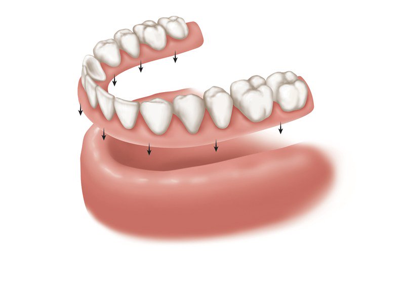 mydentalmedia's tweet image. Alternatives to dental Implants? mydentalmedia.com/groups/implant… via @mydentalmedia #implants #fixedbridge #dentures