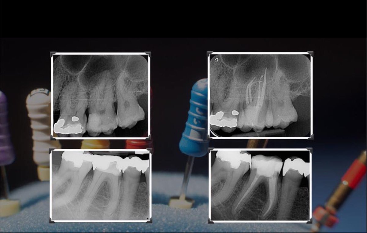 kulzerphil's tweet photo. Following a weekend in Glasgow, @I'll be in Bristol for the @CE_Endodontics course also featuring @jasonsmithson 👌 
@DentalHour #DentalHour https://t.co/cNcPhvlQ4h