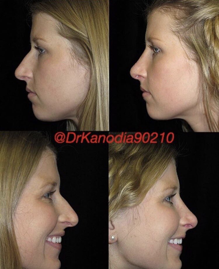 😷Treatment: CLOSED SCARLESS Rhinoplasty
🎯 Purpose: Subtle finesse nasal enhancement 
🌍 Website: drkanodia.com