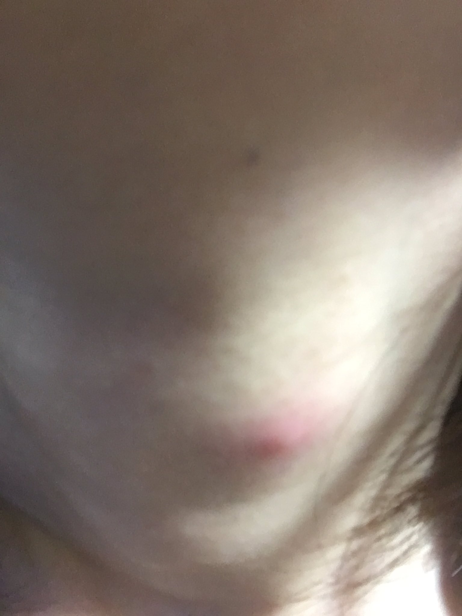 ひらやまん 首の虫刺され治らん 人 チクチク痛いしオロナインとか塗った方がいいとかいな ひらやまん 首の虫刺され治らん 人 チクチク痛いしオロナインとか塗った方がいいとかいな