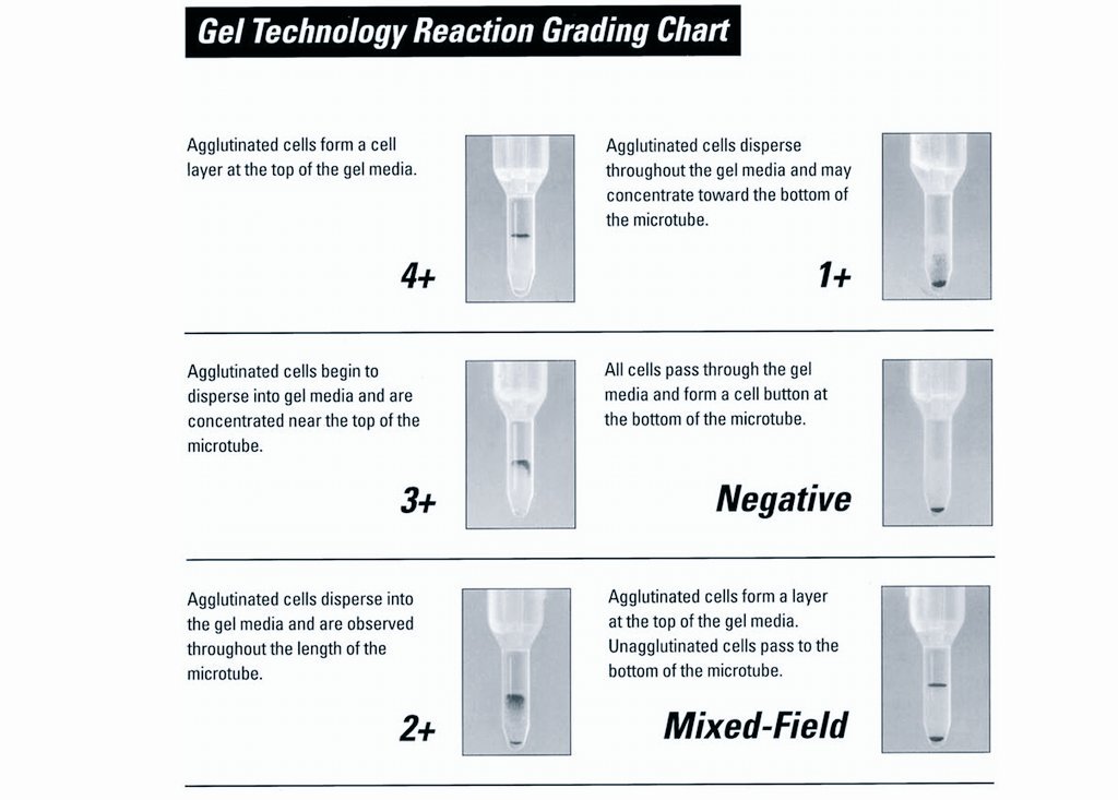 Agglutination Grading Chart