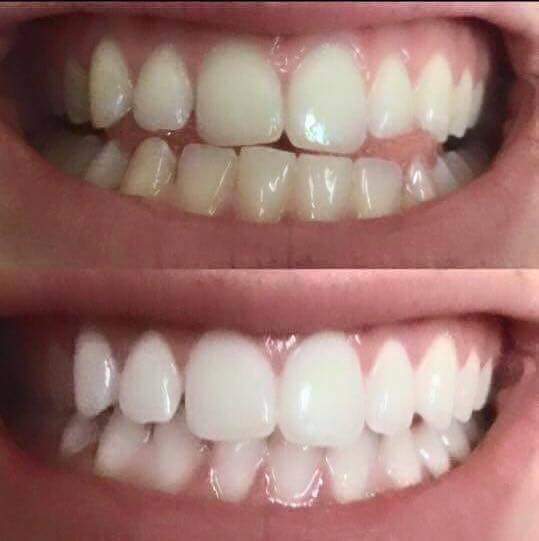 hayz_nu's tweet photo. ✅No peroxides✅No abrasives✅Safe for children✅Cleans teeth✅Removes stains.Below are distributors &amp; customer results. interested tweet me  x https://t.co/Y3SuVctAXh