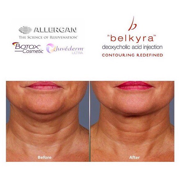 We are excited to offer #Belkyra, new to Canada and cutting edge within the industry! #ChinContouring#DoubleChin