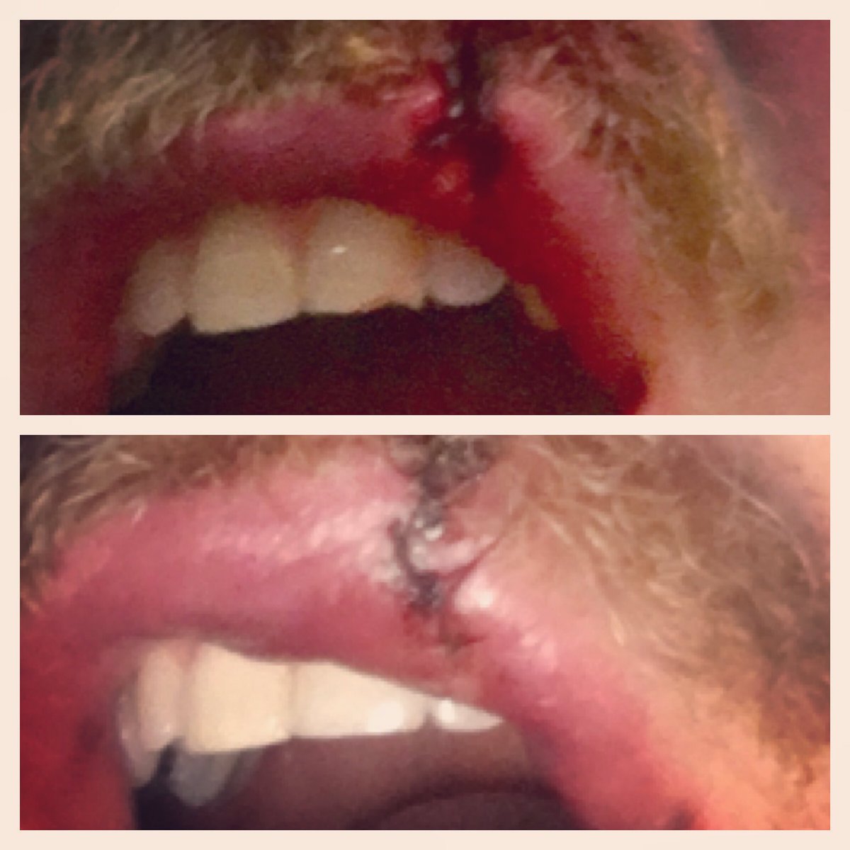 Got my tooth fixed up today #dontdrinkandskate #BoostedBoards