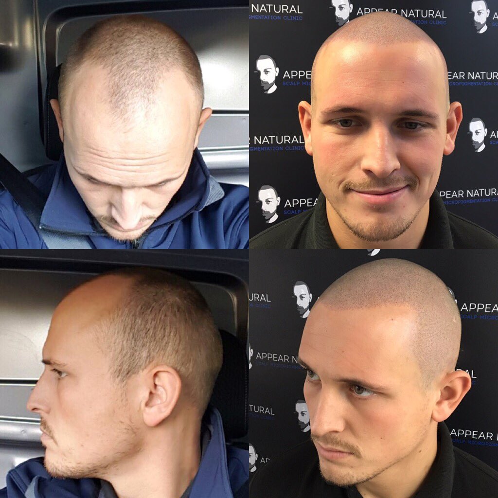 AppearN's tweet photo. Call 02037222338 to find out more about our amazing #hairloss solution @bromleyfl @BeckBromFL @WoW_Bromley @karmastudios @Bromley_UK_News https://t.co/98BToKkqkv