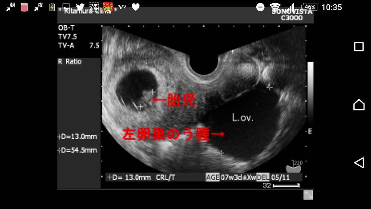 腫瘍 卵巣 卵巣のう腫・卵巣腫瘍の症状と診断法を婦人科医が解説 [婦人病・女性の病気]