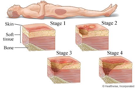 nursedibdob's tweet photo. Takeaway from #Harrogate2016 today. That red mark could be a warning of much deeper damage #reactttored #stopthepressure @NELFT (pic webmd) https://t.co/9bln0MfLY5