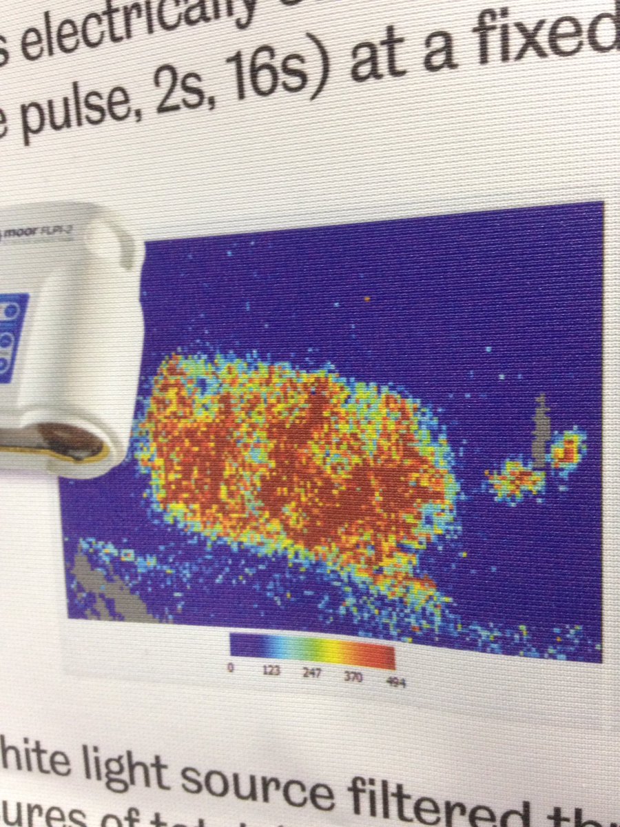 ARUKscientist's tweet photo. Really interesting work looking the effect of systemic inflammation on the neurovascular unit @Gaia_Brezzo #laserspeckle #sfn16 #teamARUK https://t.co/rfAaTz59dD