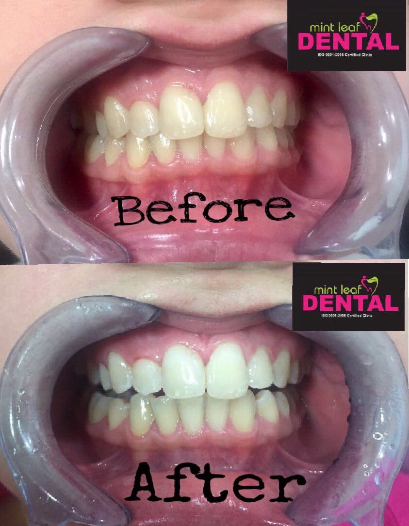 mintleafdental1's tweet photo. #TeethWhitening!!! Most natural results!!! #whiterbrighterconfidentsmile #mintleafdentalgurgaon 9278888000 https://t.co/5aN905f4dO