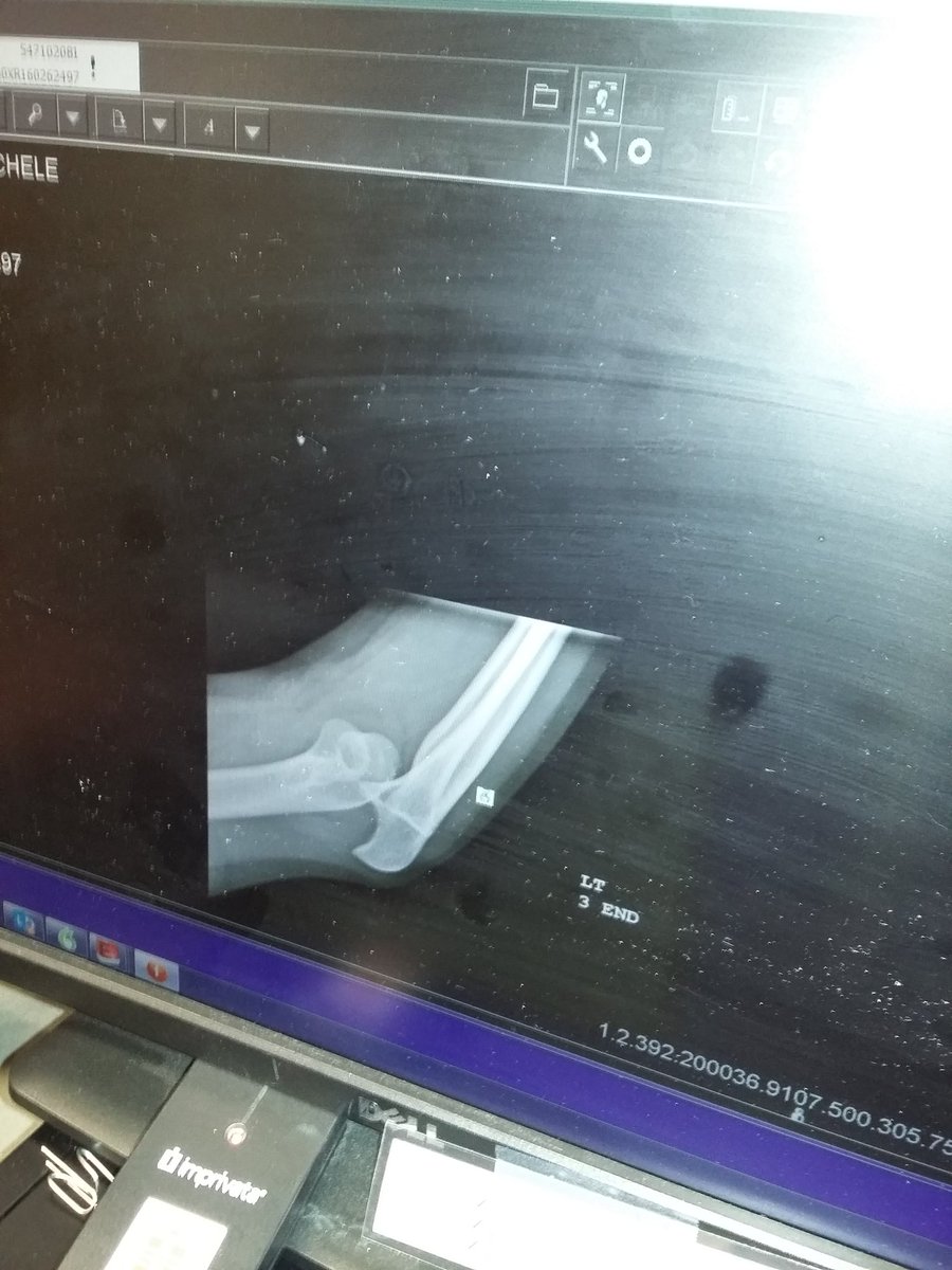 Bikercode1's tweet image. Daughter dislocated elbow doing front hand spring tonight