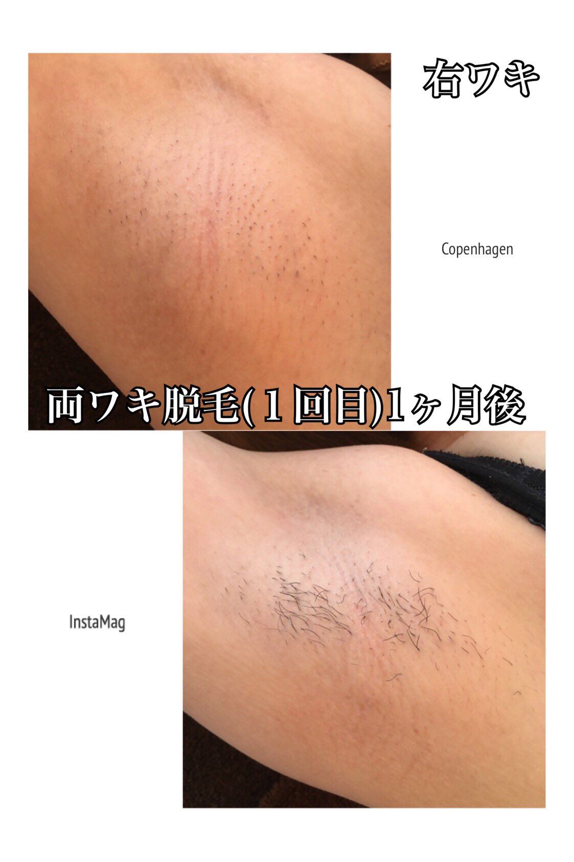 Esthetic Salon ｒ A Twitter 両ワキ脱毛モニター様 １回目 1ヶ月後 脱毛当日より１ヶ月経過してます 脱毛後より1ヶ月間 一度も毛を剃らず来店されてます もちろん写真撮影時 毛を剃ったりしていません 個人差はありますが 毛の生える速度が全然違います