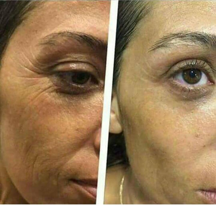 Zeitgard kullanım sonucudur 
#hepyanindayim #cilt #genclik #antiaging #kırışıklık #zeitgar… ift.tt/2erhhn5