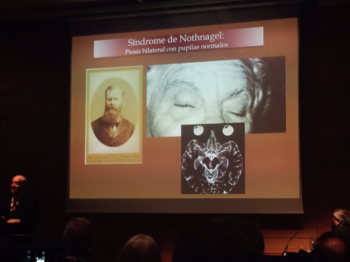 psanchlo's tweet photo. Síndrome de Nothnagel: Ptosis bilateral con pupilas normales por infarto medial de mesencéfalo. Semiologia en #rasen16 https://t.co/WCZ89Iabt2