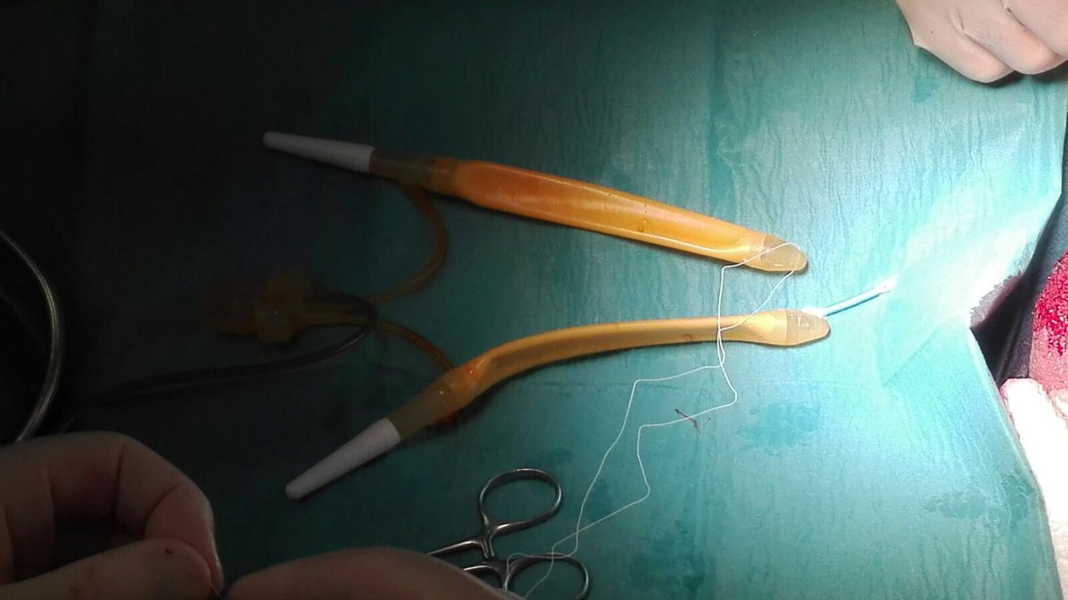 Today 2 penile prosthesis. Excellent job with <a href="/lucacindolo/">Luca Cindolo</a>