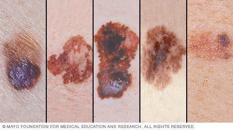 AIMatMelanoma's tweet image. #Melanoma is the deadliest form of #skincancer. Skin Cancer is the most common form of #cancer in the US