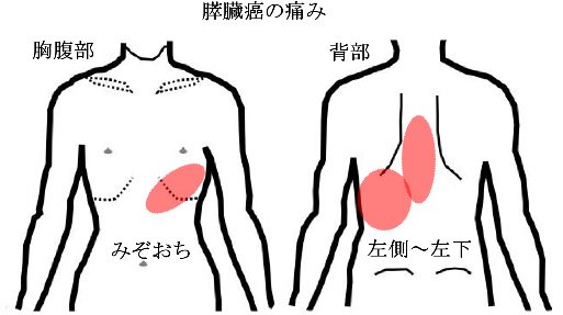 肩 甲骨 痛み 左 膵臓