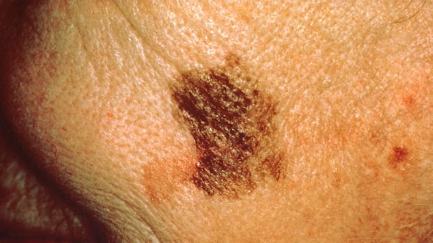 dermPA's tweet photo. New on #Dermcast | Could a #WorkplaceScreening program be effective for #melanoma prevention? | #Cancer | https://t.co/Yd0LmDVKLZ https://t.co/iushoQV2mD