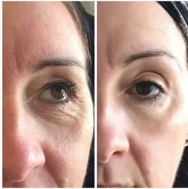 Beaut_infinity's tweet photo. Face Lift Powder&amp;Activator is such a powerful product #botoxinabottle
Can also be used with tissue to draw out impurities #byebyeblackheads https://t.co/GFCTXkPOzk