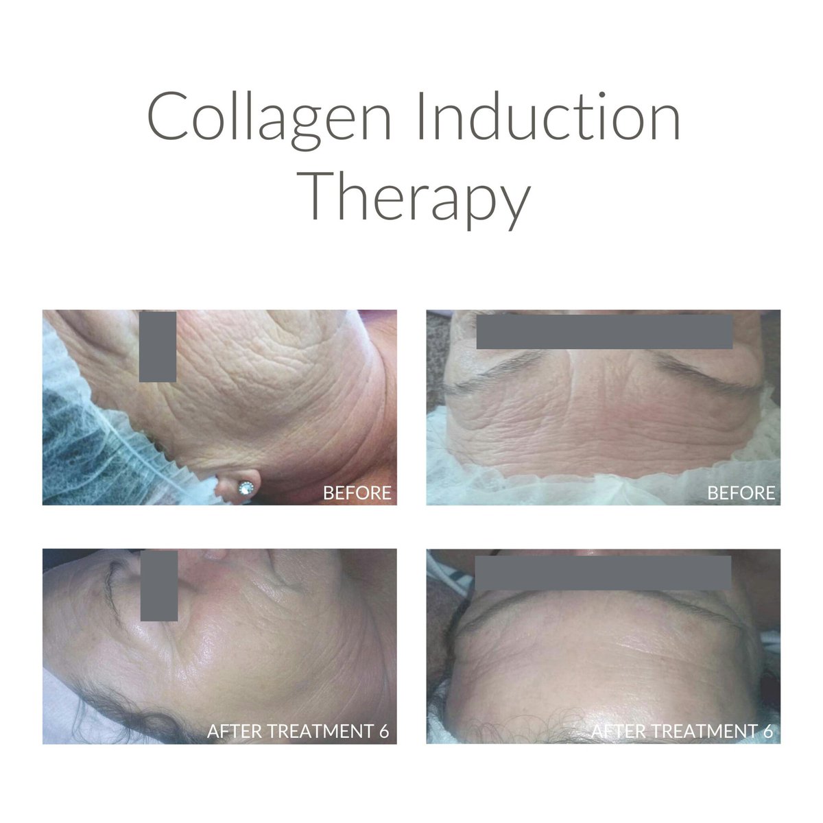 Vitaderm_s's tweet photo. Vitaderm’s Collagen Induction Therapy.Unbelievable results within just a few weeks.For more info please contact us. https://t.co/iTMeN2bduP