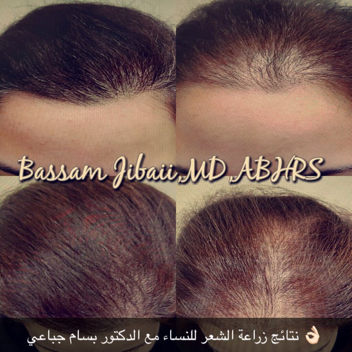 نتائج زراعة الشعر لزراعة 2500 بصيلة في - Cosmedica Arabica - Facebook