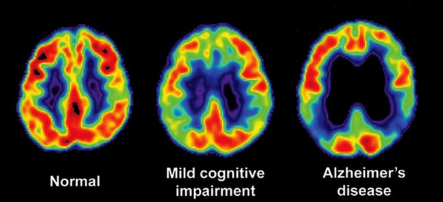 Setback for Alzheimer's with approach to remove amyloid buildup in the early disease stage in doubt ow.ly/PexR306Au5L
