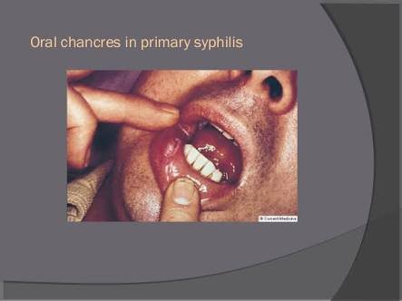 Syphilis Chancre Tongue