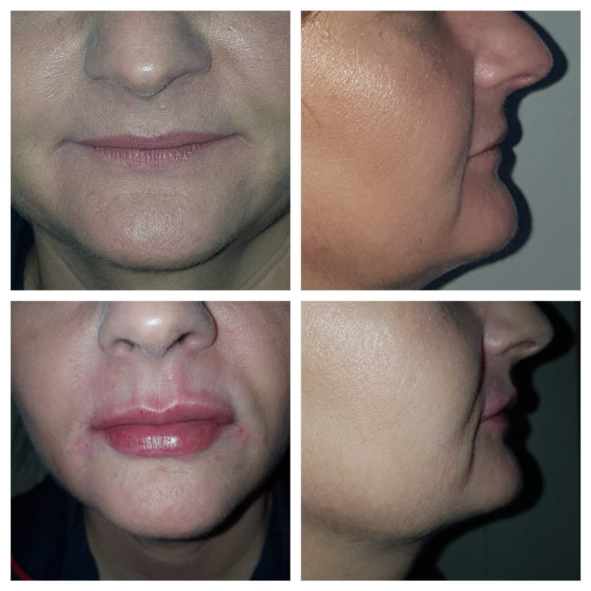 permakeup1's tweet photo. Lip fillers. Some swelling for now. Volume  definition improved. Rejovenate permanent makeup&amp; aesthetics manchester  https://t.co/oUtNfLTF75 https://t.co/tF9ptZABOY