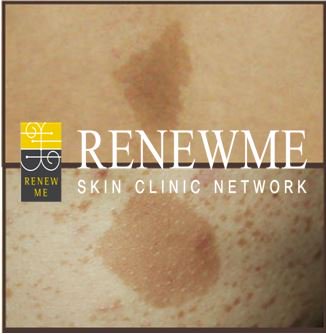 얼굴이나 몸에 생기는 얼룩덜룩한 갈색반점, 일명 #밀크커피반점 #카페오레반점 은 레이저로 지울 수 있습니다! 밀크커피반점 카페오레반점 커피색반점이 있다면 부산서면 리뉴미피부과에서 해결하세요! m.rnmeskin.com/clinic130/