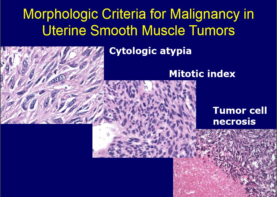 Stanford Pathology (@stanfordpath) on Twitter photo Dr. Longacre reviews the morphologic criteria for classifying smooth muscle tumors of the uterus <a href="/capath/">Ca Pathologists</a> #CSP69th #gynpath #path Dr. Longacre reviews the morphologic criteria for classifying smooth muscle tumors of the uterus <a href="/capath/">Ca Pathologists</a> #CSP69th #gynpath #path