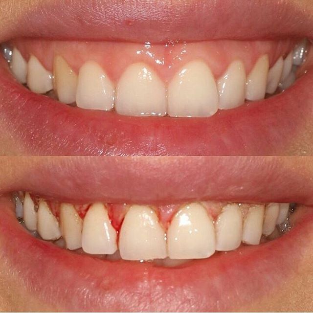 AppledentKlinik's tweet photo. Gummy smile . #botox #gummysmile #diseti #kuronboyuuzatma #estetik #smile #esthetic #dentist #dishekimi #lazer #gingivectomy #appledent https://t.co/fQpG6ptKsQ