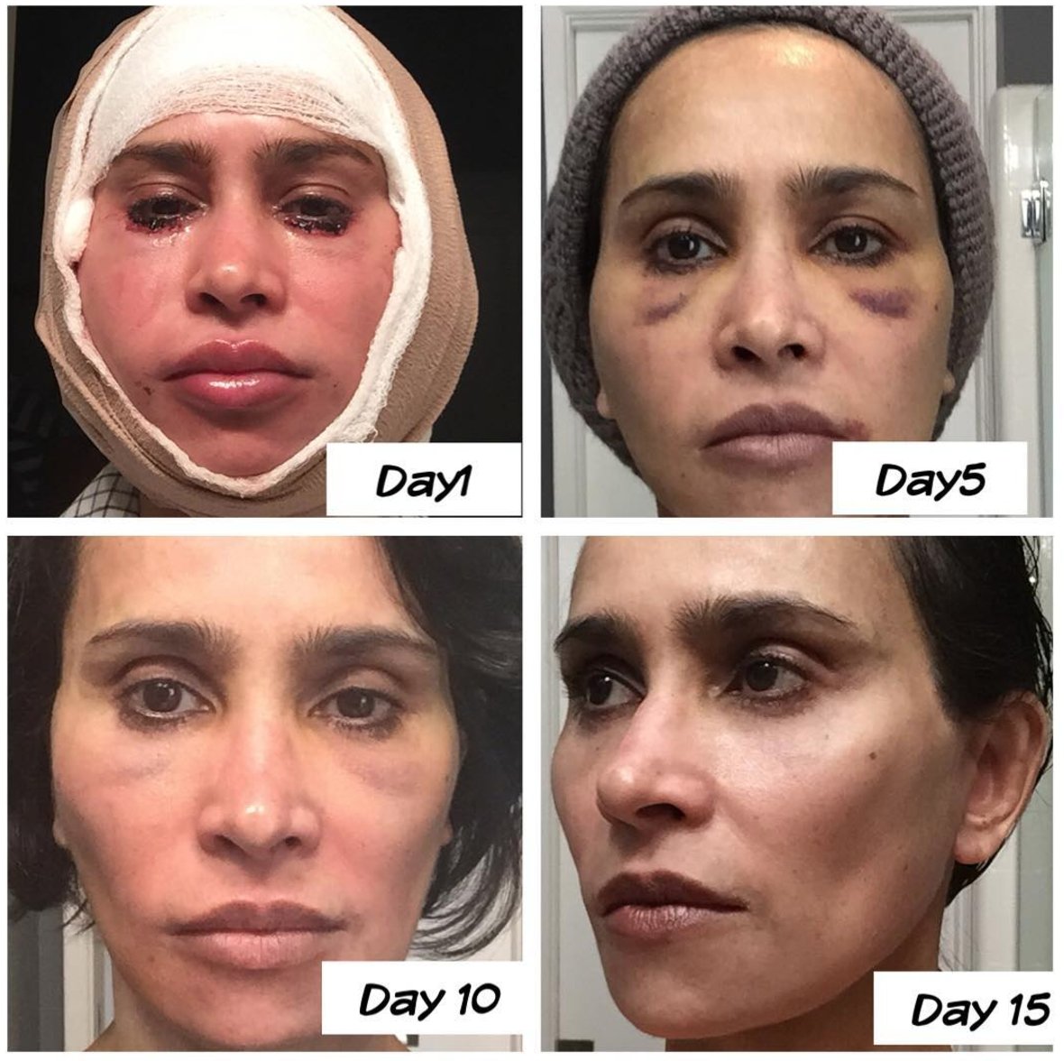 SkinSpecifics's tweet photo. My face&amp;neck lift journey.do I still need fillers and neurotoxin like #dysport or #botox ... sure, but not as often...@SkinSpecifics #medspa https://t.co/KmCQZvJQdy