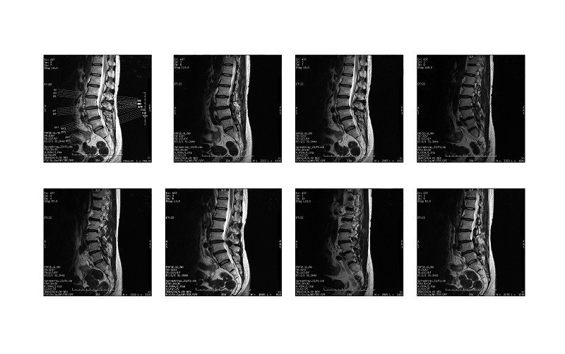 Dean_Chiro's tweet photo. Degenerative Disc Disease: How a Chiropractor Can Help https://t.co/KvFtsqWZDI https://t.co/OIwZZQkB0b