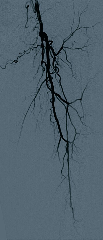 AlbanyIR's tweet photo. Severe intermittent claudication. SFA occlusion. @SIRRFS #irad @Mustapja #legs4life @BostonPIMedEd #downwithPADyehyouknowme #rapreference https://t.co/SwqU7mFR2E