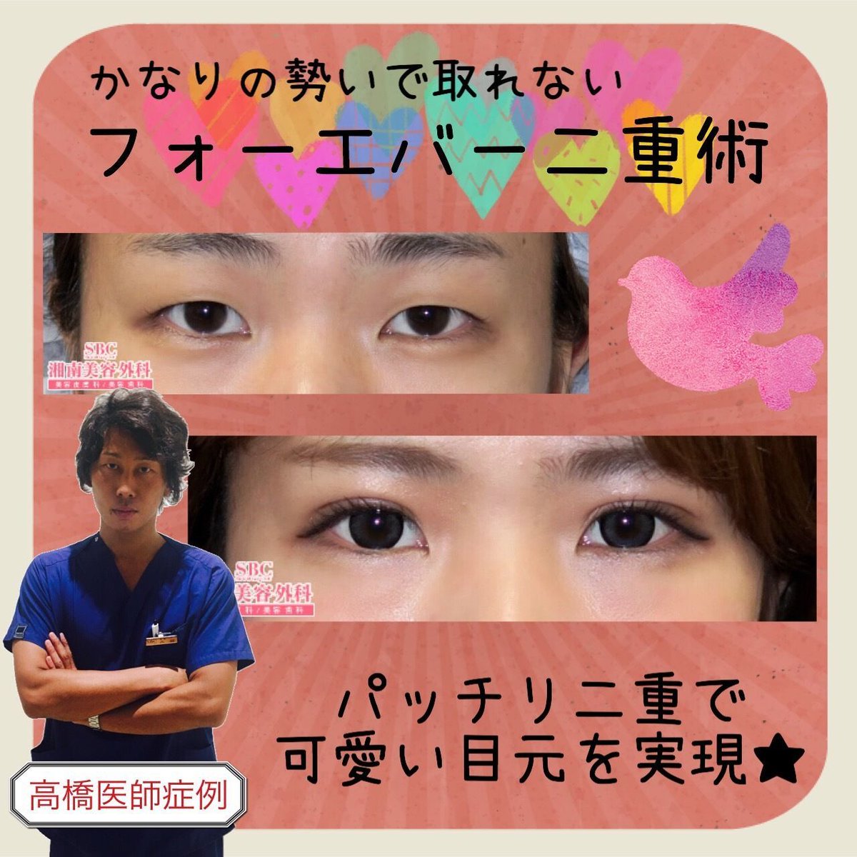 湘南美容クリニック 池袋東口院 No Twitter パッチリ幅広二重にしたい 厚く腫れぼったい瞼を可愛い二重にしたい そんな時はフォーエバー 二重術 目玉治療 T Co Xmkyd1u76l 更にお得なモニター T Co 0f2638tz6r 湘南美容外科 二重 整形