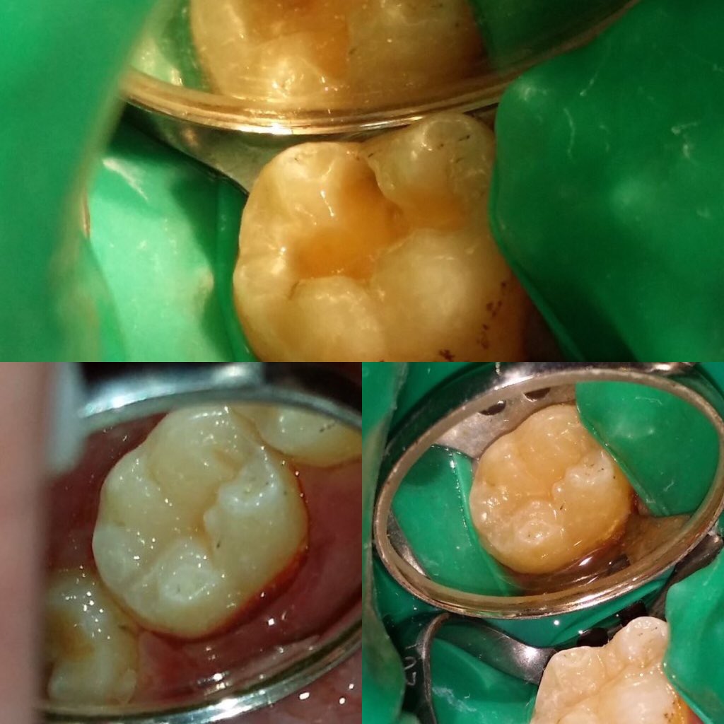 KhalidAlashry2's tweet photo. #Posterior_composite #Stamp #Lower6 https://t.co/vFy2HDGfKN