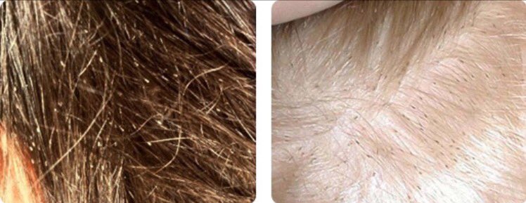 Heavy Infestations Make Your Child's Life a Living Hell.For heavy infestations we will tackle the nits with 2 lice assassins. #nits #lice