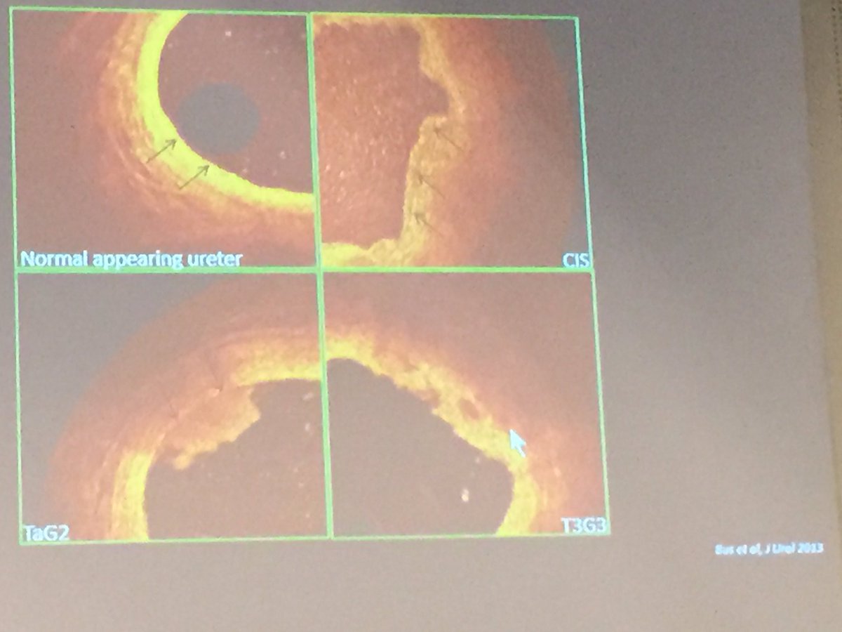 enriquegomezgo4's tweet photo. @ResidentesAEU #ESUI16 Dr Bus -OCT and CLE can improve UTUC stratification https://t.co/mfSF8NEd4K